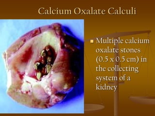 Calcium Oxalate Calculi
 Multiple calcium
oxalate stones
(0.5 x 0.5 cm) in
the collecting
system of a
kidney
 