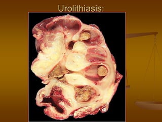 Urolithiasis:
 