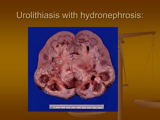 Urolithiasis with hydronephrosis:
 