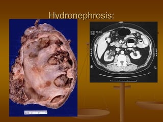 Hydronephrosis:
 