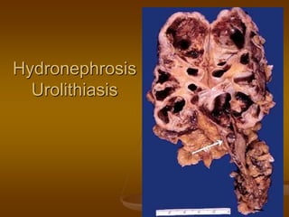Hydronephrosis
Urolithiasis
 