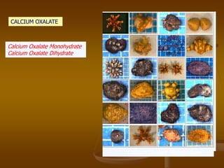 Calcium Oxalate Monohydrate
Calcium Oxalate Monohydrate
Calcium Oxalate Dihydrate
CALCIUM OXALATE
 