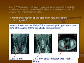 Case 1. A 32 yr presents with acute R sided abd. colic in casualty that started in
early hrs of morning, he has previous H/O lithuria 4 yrs previously. He has mild
temp. Vomiting and is tender in the RIF.
3. Which investigation at this stage can help in clinching
the diagnosis?
Non contrast spiral or HelicalCT scan – will pick up stone in over
97% of the cases ( 97% specificity, 96% specificity)
12 x 10 mm 7 x 7 mm calculi in lower third Right
Ureter
 