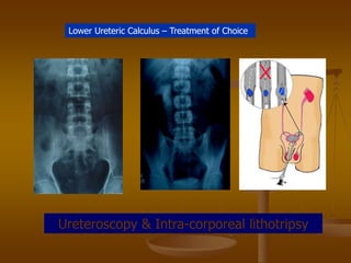 Lower Ureteric Calculus – Treatment of Choice
Ureteroscopy & Intra-corporeal lithotripsy
 