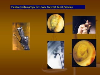 Flexible Ureteroscopy for Lower Calyceal Renal Calculus
 
