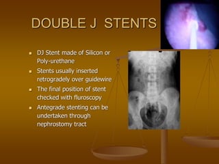 DOUBLE J STENTS
 DJ Stent made of Silicon or
Poly-urethane
 Stents usually inserted
retrogradely over guidewire
 The final position of stent
checked with fluroscopy
 Antegrade stenting can be
undertaken through
nephrostomy tract
 