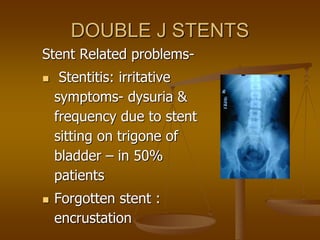 DOUBLE J STENTS
Stent Related problems-
 Stentitis: irritative
symptoms- dysuria &
frequency due to stent
sitting on trigone of
bladder – in 50%
patients
 Forgotten stent :
encrustation
 