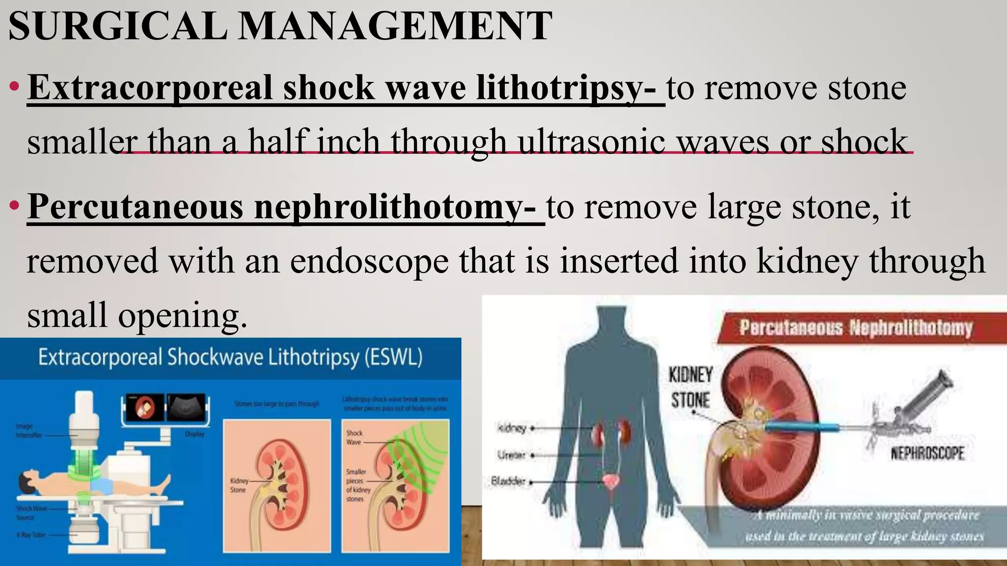 SURGICAL MANAGEMENT
•Extracorporeal shock wave lithotripsy- to remove stone
smaller than a half inch through ultrasonic waves or shock
•Percutaneous nephrolithotomy- to remove large stone, it
removed with an endoscope that is inserted into kidney through
small opening.