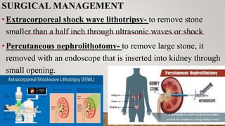 SURGICAL MANAGEMENT
•Extracorporeal shock wave lithotripsy- to remove stone
smaller than a half inch through ultrasonic waves or shock
•Percutaneous nephrolithotomy- to remove large stone, it
removed with an endoscope that is inserted into kidney through
small opening.
 