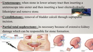• Ureteroscopy- when stone in lower urinary tract then inserting a
ureteroscope into ureter and then inserting a laser electrohydraulic
lithotripter and remove stone.
• Cystolithotomy- removal of bladder calculi through suprapubic
incision.
• Partial total nephrectomy- its necessary because of extensive kidney
damage which can be responsible for stone formation.
 