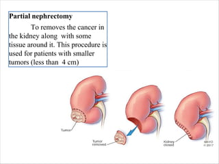 Partial nephrectomy
To removes the cancer in
the kidney along with some
tissue around it. This procedure is
used for patients with smaller
tumors (less than 4 cm)
 