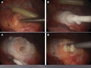 AvançosnaTécnicaInserção de probe nalesãotumoral -Temperaturamínima: - 19.4 0 C2 ciclos de congelamentorápido (nitrogênioouargôniolíquidos), seguido de  reaquecimento gradual (gáshélio)Áreacongeladadeveultrapassar as margenstumorais- 5 a 10 mm.Stephenson RA, King DK, Rohr LR. Renal cryoablation in a canine model. Urology 1996; 47:772.Campbell SC, Krishnamurthi V, Chow G, et al. Renal cryosurgery: experimental evaluation of treatment parameters. Urology 1998;52:29.