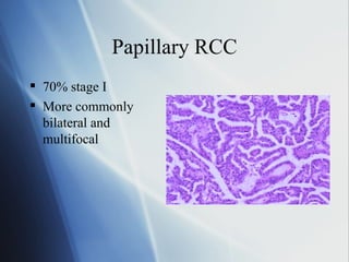 Multifocal Rcc Radiology Renal Cancers Rationale | PPT
