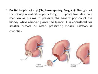 RENAL CELL CANCER for adult health nursing.pptx