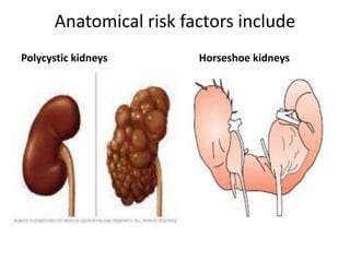 Anatomical risk factors include
Polycystic kidneys Horseshoe kidneys
 