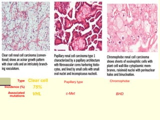 Renal cell carcinoma | PPT