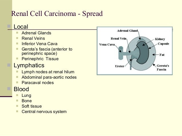 Renal Cell Carcinoma