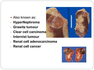  Also known as:
- HyperNephroma
- Grawitz tumour
- Clear cell carcinoma
- Internist tumour
- Renal cell adenocarcinoma
- Renal cell cancer
 