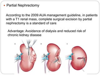  Partial Nephrectomy
According to the 2009 AUA management guideline, in patients
with a T1 renal mass, complete surgical excision by partial
nephrectomy is a standard of care
Advantage: Avoidance of dialysis and reduced risk of
chronic kidney disease
 