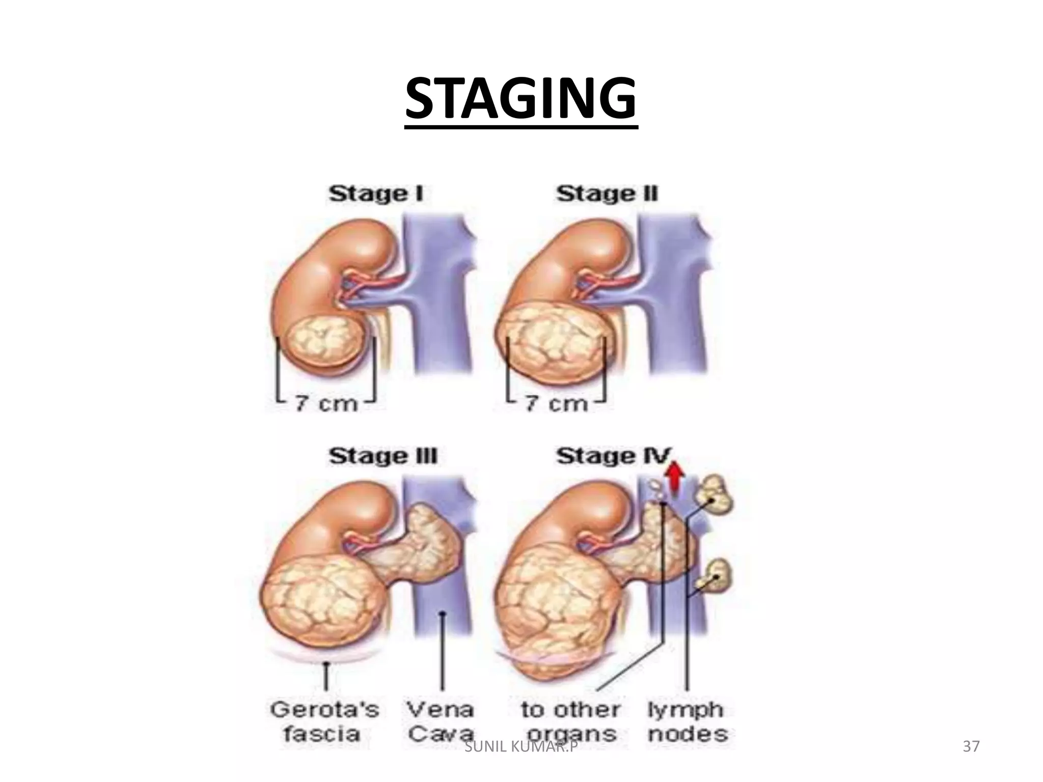 Renal cell carcinoma | PPTX