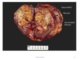 Renal cell carcinoma | PPTX