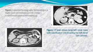 Figure:Computedtomographydemonstrates a
right renalcarcinoma(m) with alarge
contralateral adrenalmetastasis(a).
Figure: CTscan shows large left renal mass
with calcification (m) invading the left renal
vein (arrow).
12
 