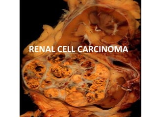 RENAL CELL CARCINOMA
 