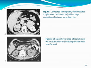 RENAL CELL CARCINOMA PATHOGENESIS AND CLASSIFICATION | PPTX