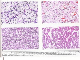 Renal Cell Carcinoma Diagnosis And Management | PPT
