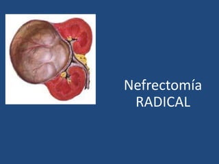 Nefrectomía
RADICAL
 
