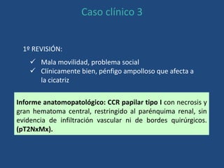 Caso clínico 3
Informe anatomopatológico: CCR papilar tipo I con necrosis y
gran hematoma central, restringido al parénquima renal, sin
evidencia de infiltración vascular ni de bordes quirúrgicos.
(pT2NxMx).
 Mala movilidad, problema social
 Clínicamente bien, pénfigo ampolloso que afecta a
la cicatriz
1º REVISIÓN:
 