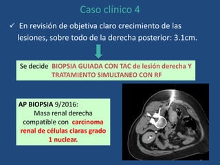 Caso clínico 4
 En revisión de objetiva claro crecimiento de las
lesiones, sobre todo de la derecha posterior: 3.1cm.
Se decide BIOPSIA GUIADA CON TAC de lesión derecha Y
TRATAMIENTO SIMULTANEO CON RF
AP BIOPSIA 9/2016:
Masa renal derecha
compatible con carcinoma
renal de células claras grado
1 nuclear.
 
