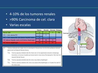 • 4-10% de los tumores renales
• >90% Carcinoma de cel. clara
• Varias escalas
 