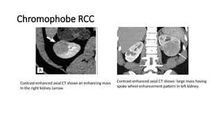 Renal triphasic CT and malignancy .pptx