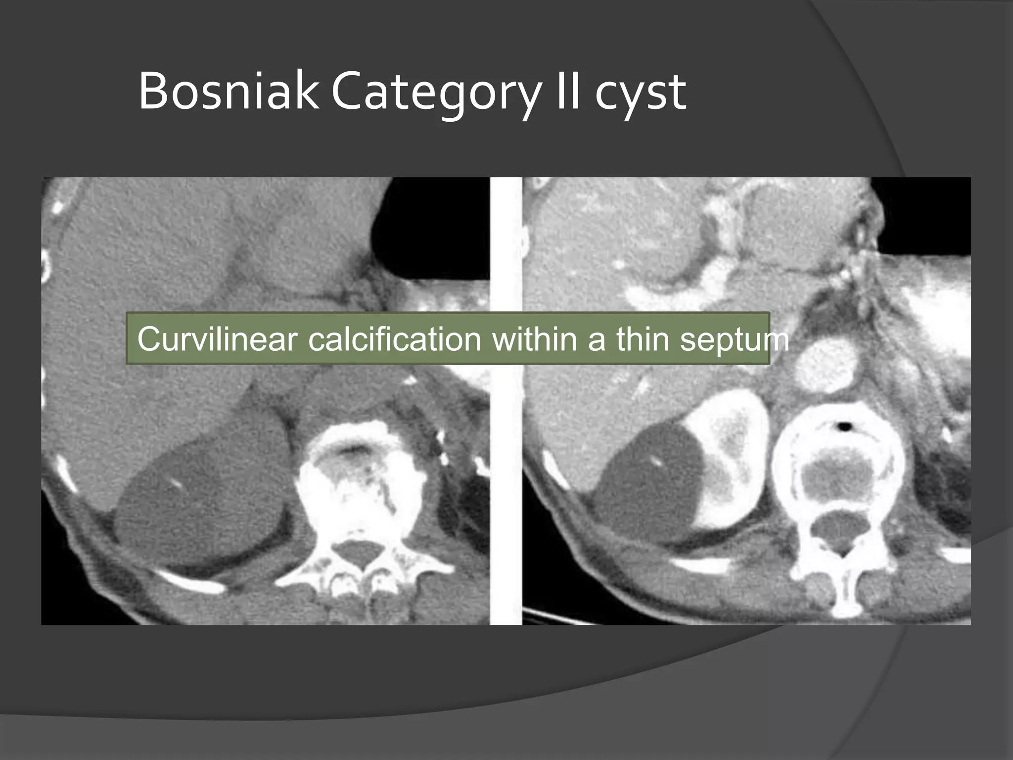 Renal cyst / Classification of Renal Cyst | PPTX