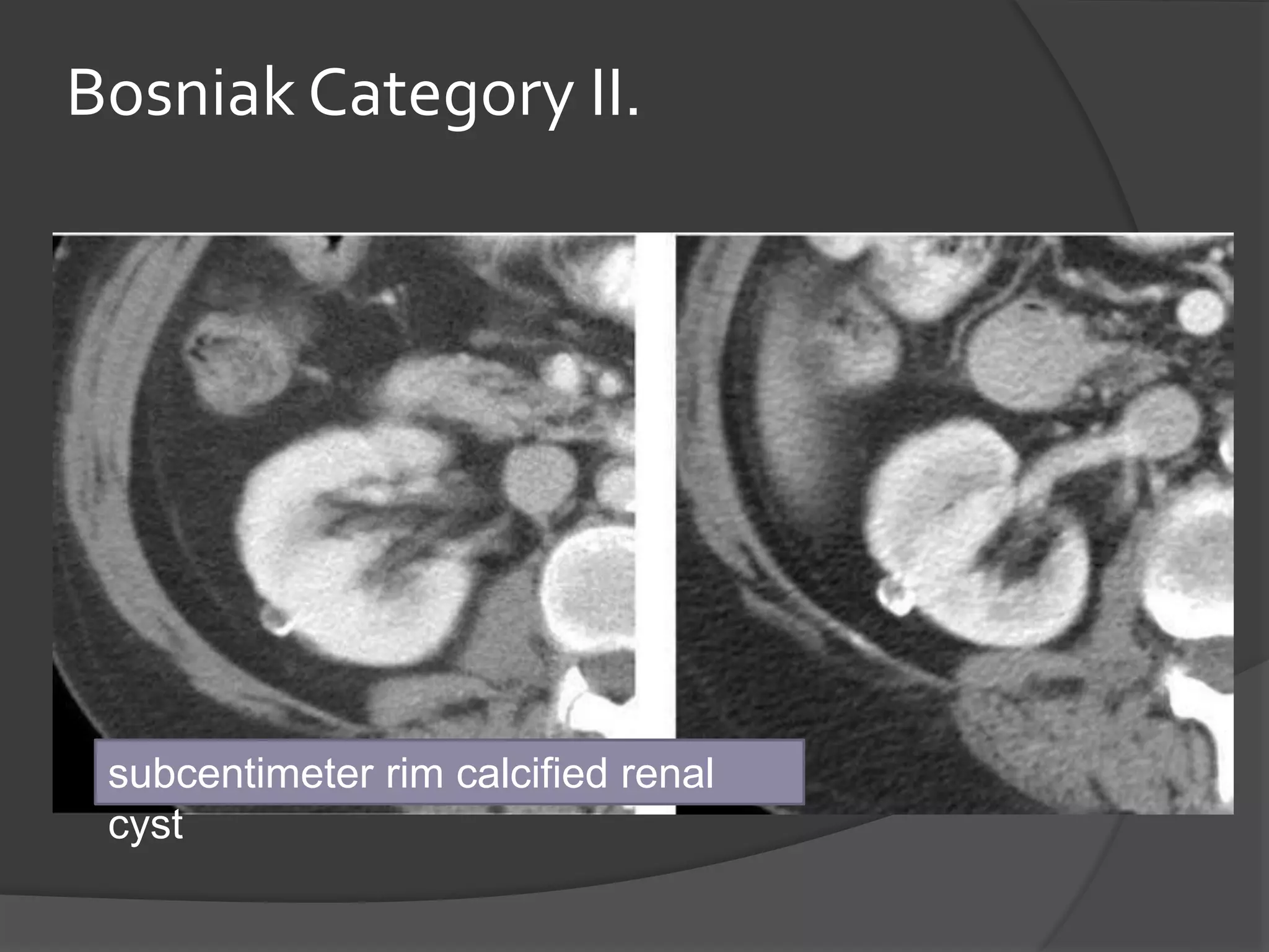 Renal cyst / Classification of Renal Cyst | PPTX