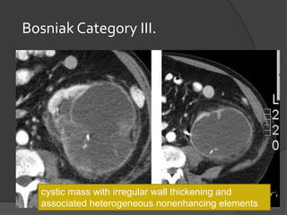 Bosniak Category III.
cystic mass with irregular wall thickening and
associated heterogeneous nonenhancing elements
 