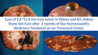Renal cyst Tumor and Homoeopathy