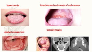 Xerostomia Petechiae and ecchymosis of oral mucosa
gingival enlargement
Osteodystrophy
 