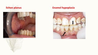 lichen planus Enamel hypoplasia
 