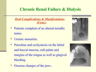 Chronic Renal Failure & Dialysis
Oral Complications & Manifestations
(Cont.)
 Patients complain of an altered metallic
tastes.
 Uremic stomatitis.
 Petechiae and ecchymosis on the labial
and buccal mucosa, soft palate and
margins of the tongue as well as gingival
bleeding.
 Osseous changes of the jaws.
 