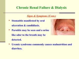 Chronic Renal Failure & Dialysis
Signs & Symptoms (Cont.)
 Stomatitis manifested by oral
ulceration & candidiasis.
 Parotitis may be seen and a urine
like odor to the breath may be
detected.
 Uremic syndrome commonly causes malnutrition and
diarrhea.
 