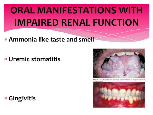 dental-management-of-a-renal-disorder-patient