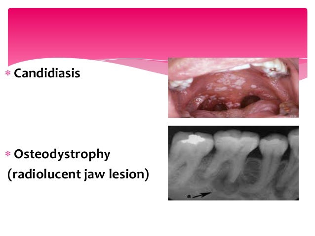 dental-management-of-a-renal-disorder-patient