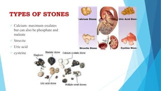 TYPES OF STONES
 Calcium- maximum oxalates
but can also be phosphate and
maleate
 Struvite
 Uric acid
 cysteine
 