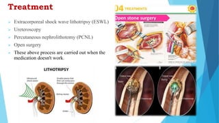Treatment
 Extracorporeal shock wave lithotripsy (ESWL)
 Ureteroscopy
 Percutaneous nephrolithotomy (PCNL)
 Open surgery
 These above process are carried out when the
medication doesn't work.
 