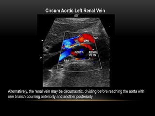 Circum Aortic Left Renal Vein
Alternatively, the renal vein may be circumaortic, dividing before reaching the aorta with
one branch coursing anteriorly and another posteriorly
 