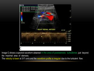 Image C shows a spectral waveform obtained in the area of poststenotic turbulence just beyond
the maximal area of stenosis.
The velocity is lower at 317 cm/s and the waveform profile is irregular due to the turbulent flow.
 