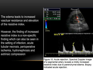 The edema leads to increased
vascluar resistance and elevation
of the resistive index.
However, the finding of increased
resistive index is a non-specific
finding which can also be seen in
the setting of infection, acute
tubular necrosis, perioperative
ischemia, hydronephrosis and
extrinsic compression
 