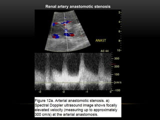 Renal artery anastomotic stenosis
 